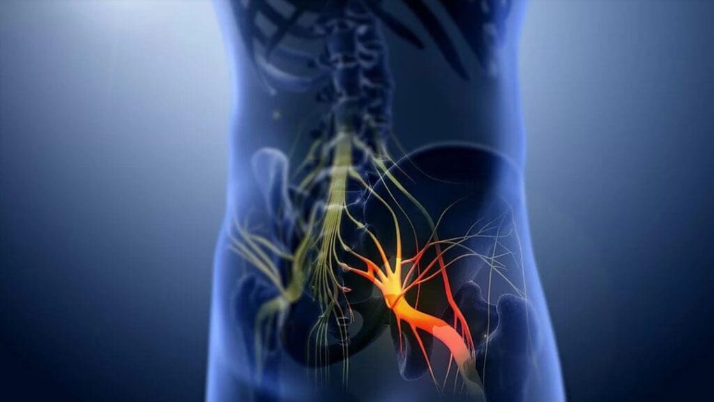 ChiroMed: Sciatic Nerve Compression After Injury